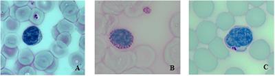 Vacuolated PAS-Positive Lymphocytes on Blood Smear: An Easy Screening Tool and a Possible Biomarker for Monitoring Therapeutic Responses in Late Onset Pompe Disease (LOPD)